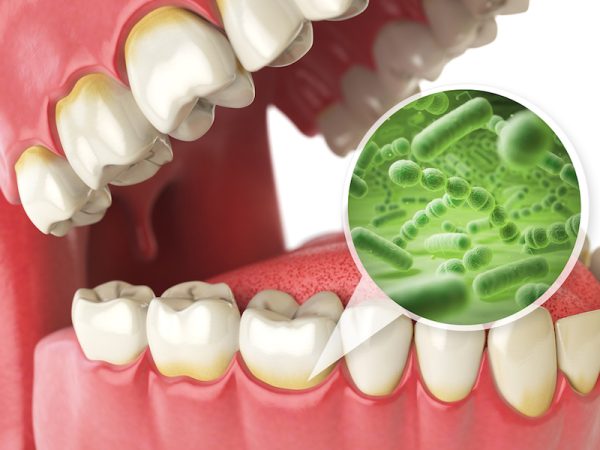 Mảng bám là môi trường lý tưởng để vi khuẩn phát triển và gây bệnh viêm chân răng