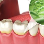 Tìm hiểu về bệnh lý viêm chân răng mãn tính