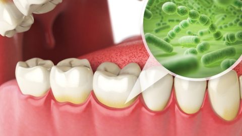 Tìm hiểu về bệnh lý viêm chân răng mãn tính