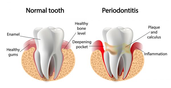 Viêm cuống răng bán cấp tín có thể sốt nhẹ hoặc không sốt, phần mô mềm quanh răng sưng tấy...