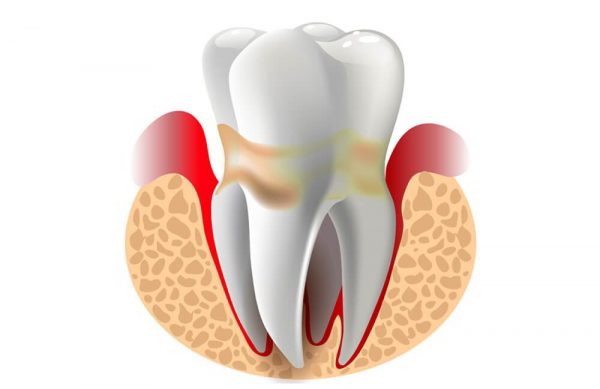 Khi bị viêm quanh cuống răng cấp tính, người bệnh thường có các biểu hiện như đau nhức, khó chịu, sốt cao trên 38 độ C...
