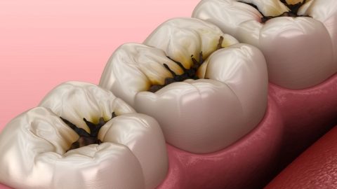 Giải đáp: Bị sâu răng có tẩy trắng được không?