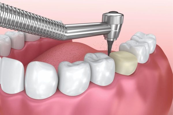 Bọc răng sứ có phải nhổ răng không còn tùy thuộc vào tình trạng răng miệng của mỗi người