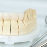 Tìm hiểu tất tần tật về bọc răng sứ titan