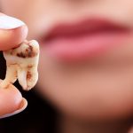 Tìm hiểu các cách chữa viêm chân răng hữu ích