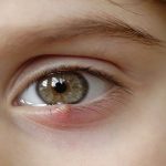 7 Cách Trị Lẹo Mắt Hiệu Quả | Bạn đã biết?