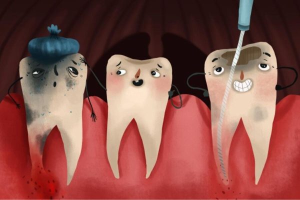 Viêm chân răng là bệnh lý có liên quan đến các tổ chức quanh răng do vi khuẩn tấn công mạnh mẽ gây sưng, viêm