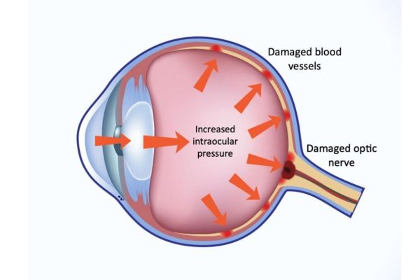 Tăng nhãn áp còn được gọi là thiên đầu thống, một bệnh lý xảy ra khi áp lực thủy dịch bên trong nhãn cầu tăng cao gây áp lực lên mắt