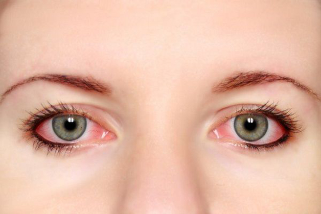 Đau mắt đỏ là tên dân gian thường gọi của bệnh viêm kết mạc… kết mạc mi bị viêm nhiễm. Vậy đau mắt đỏ kiêng ăn gì?