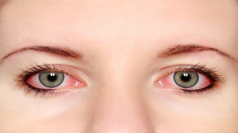 Bệnh đau mắt đỏ kiêng gì để mau khỏi?