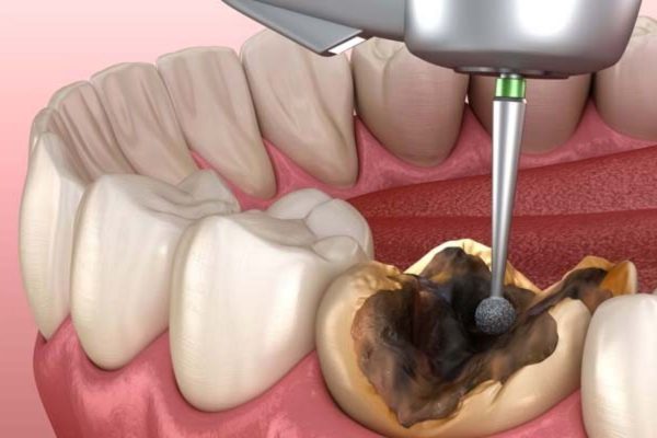 Các bệnh lý như sâu răng, viêm nha chu... khiến răng số 7 dễ bị vi khuẩn tấn công gây viêm nhiễm tủy răng