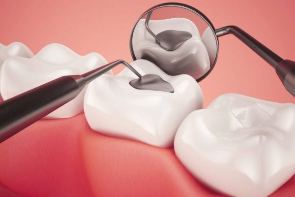 Điều trị tủy răng số 7 bằng việc hút tủy viêm và hàn kín ống tủy 