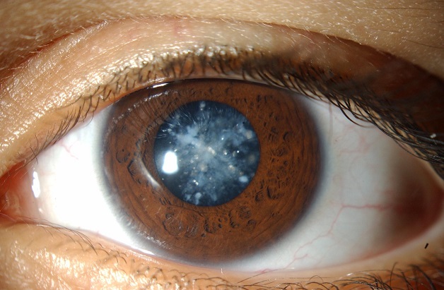 Đục thủy tinh thể là một trong những nguyên nhân hàng đầu gây mù lòa