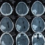 Giúp bạn hiểu rõ về kỹ thuật chụp CT sọ não