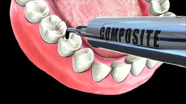 Hàn răng sâu có được lâu không còn phụ thuộc vào nhiều yếu tố như: Chất liệu hàn, kỹ thuật, tay nghề của bác sĩ...