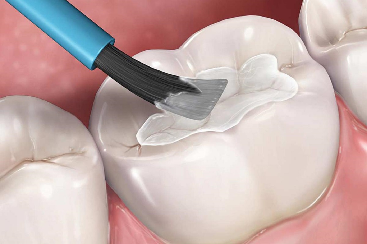  Hàn răng có lâu không - Cách hàn răng và lâu trên bề mặt răng