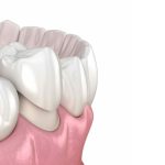 Khi nào nên bọc răng sứ để đạt hiệu quả tốt nhất?