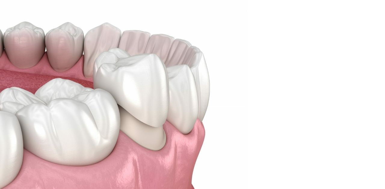Có cần phải rụng răng trẻ con để bọc răng sứ?
