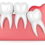 Lợi trùm răng khôn: Dấu hiệu nhận biết và cách xử trí