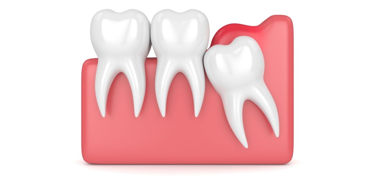 Nguyên nhân nào dẫn đến viêm lợi trùm răng số 8?
