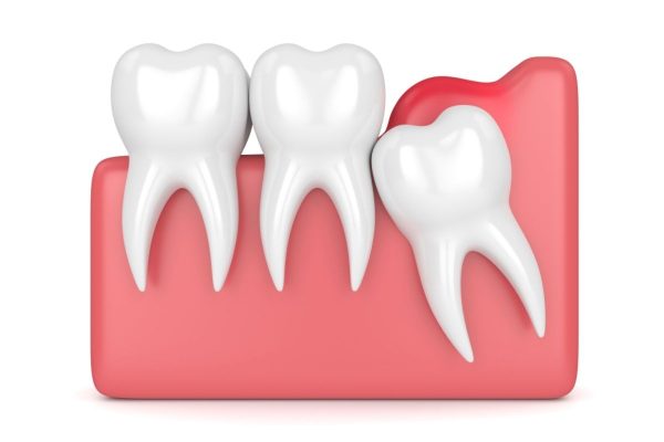 Lợi trùm răng khôn là hiện tượng phần lợi phía trong hàm bao phủ lên bề mặt của răng, ngăn cho răng mọc lên