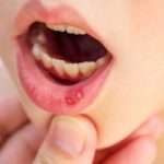 Tìm hiểu các nguyên nhân bị sưng nướu răng 