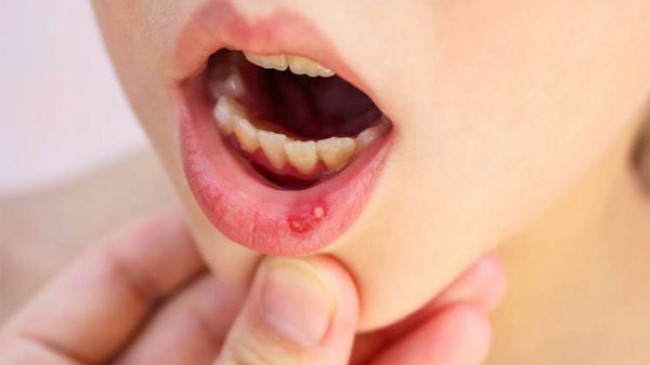 Có những nguyên nhân gì dẫn đến sưng nướu răng?
