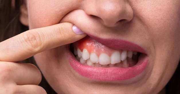 Viêm chân răng (hay còn được biết đến với tên gọi viêm nha chu) là sự tổn thương các tổ chức ở xung quanh răng và chân răng.