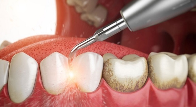 Nguyên nhân dẫn đến viêm lợi có thể là do mảng bám cao răng 