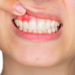 Tìm hiểu một số nguyên nhân sưng chân răng 