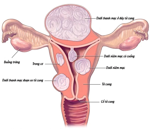 Rong kinh là một trong những biểu hiện của u xơ tử cung