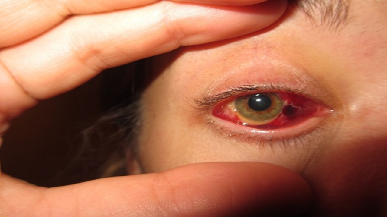Phương pháp điều trị rách màng mắt là gì?
