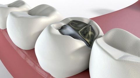 Răng hàm số 6 bị sâu: Nguyên nhân và cách điều trị
