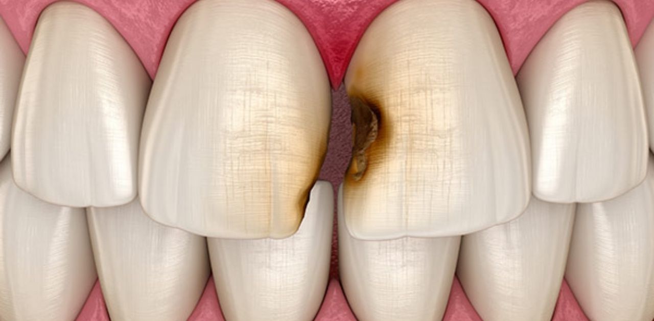 Nguyên nhân và biểu hiện của răng sâu kẽ mà bạn cần biết