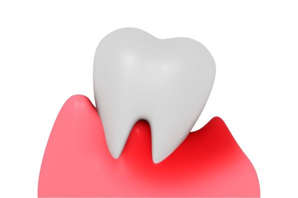 Sâu răng hàm số 8 do nhiều nguyên nhân như bị ảnh hưởng bởi các bệnh lý răng miệng: Viêm nha chu, viêm tủy răng...