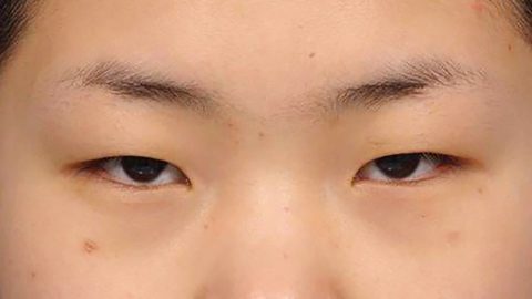 Sụp mí mắt: Nguyên nhân, dấu hiệu và cách khắc phục