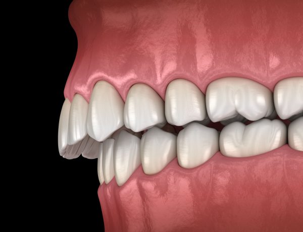 Tại sao răng bị hô? Làm thế nào để khắc phục răng hô? | TCI Hospital