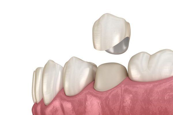 Bọc sứ giúp mọi người sở hữu hàm răng đều, đẹp và trắng sáng tự nhiên