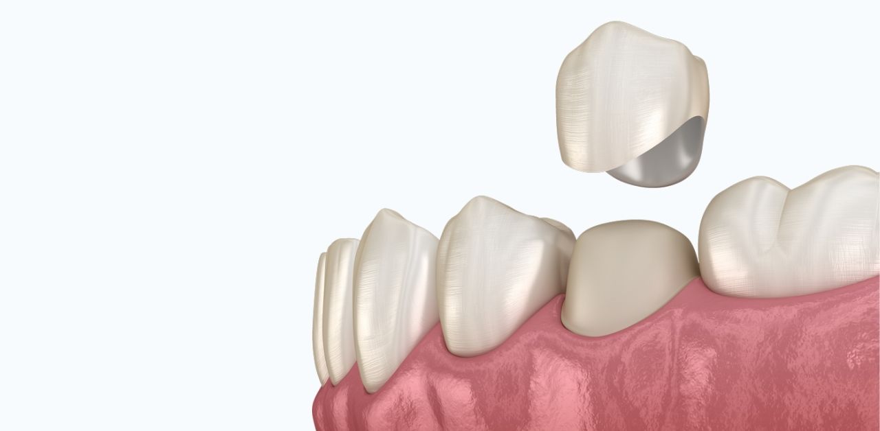 Quá trình làm răng sứ bao gồm những bước nào?
