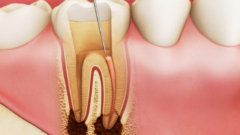 Tìm hiểu những triệu chứng viêm quanh cuống răng 