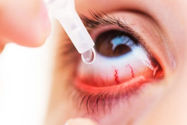 Bệnh viêm kết mạc dị ứng cấp thường có các biểu hiện như mắt đổ, cộm, có nhiều ghèn...
