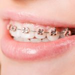 Viêm nướu khi niềng răng: Nguyên nhân và cách khắc phục 