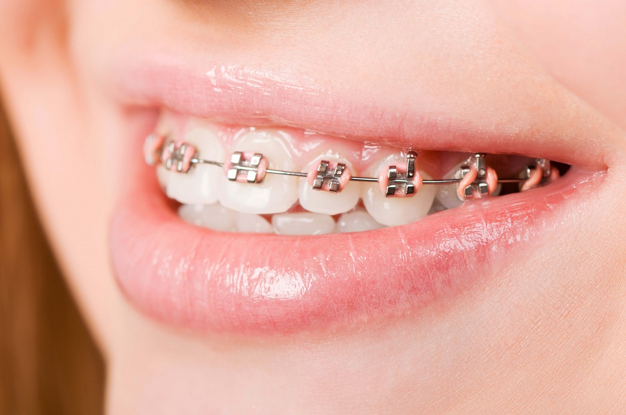 Nguyên nhân và cách điều trị viêm lợi khi niềng răng 