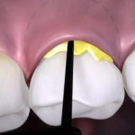 Bác sĩ nha khoa giải đáp: Viêm quanh cuống răng là gì?