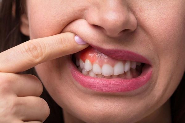 Khi bị viêm quanh cuống răng, người bệnh thường có các biểu hiện đau nhức, sưng tấy vùng nướu...
