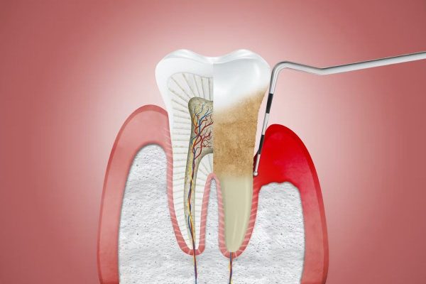 Viêm quanh cuống răng là gì? - Là tình trạng viêm nhiễm làm tổn thương các mô quanh cuống răng