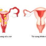 Ăn gì để hết u xơ tử cung – Mẹ bầu cần lưu ý