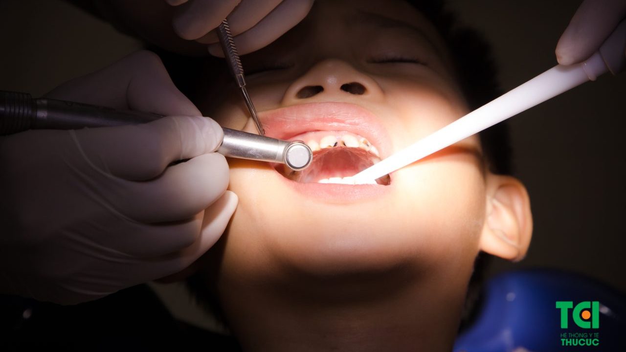 Làm cách nào để điều trị răng sâu cho bé?
