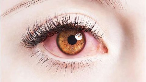 Bệnh đau mắt đỏ có nguy hiểm không? Điều trị thế nào?