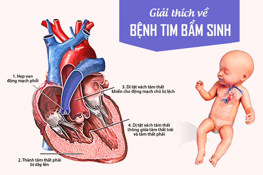1 số dạng dị tật tim bẩm sinh được phát hiện qua khám sàng lọc thai nhi